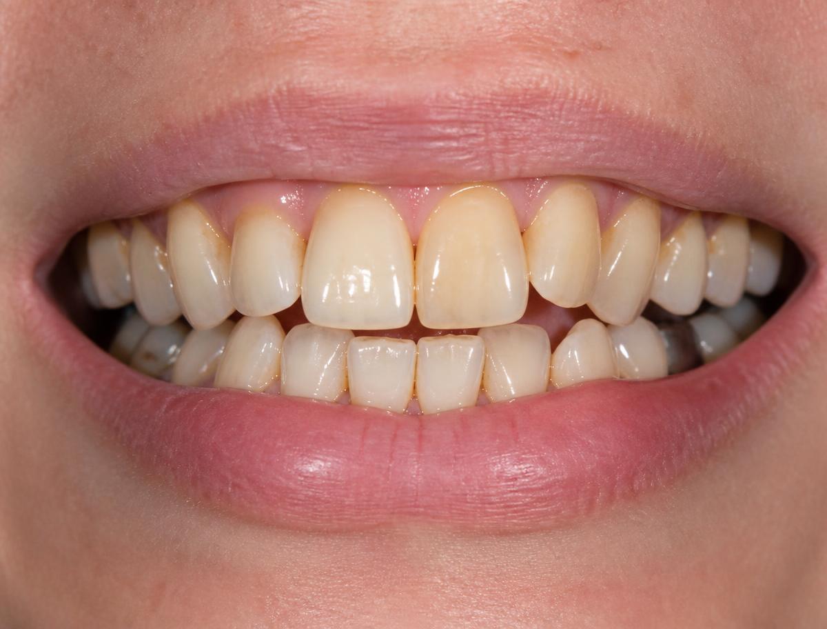 Transformação do sorriso da paciente — Antes